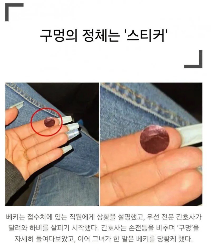  약혐) 입천장에 구멍 뚫린 아기