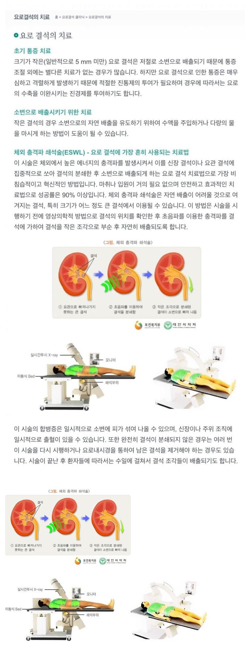 (후방주의) 요로결석 빼내는 시술