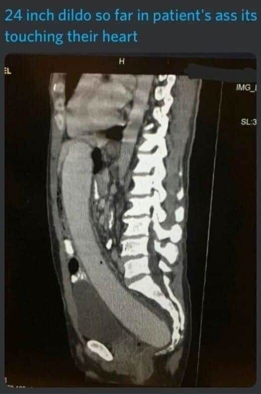 24인치 딜도가 안빠져서 병원온 사람의mri사진