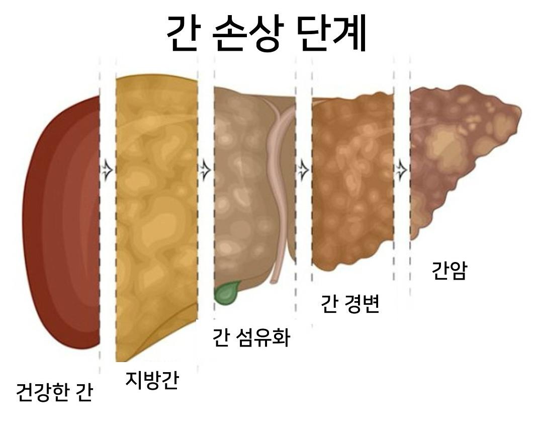 간 손상 단계