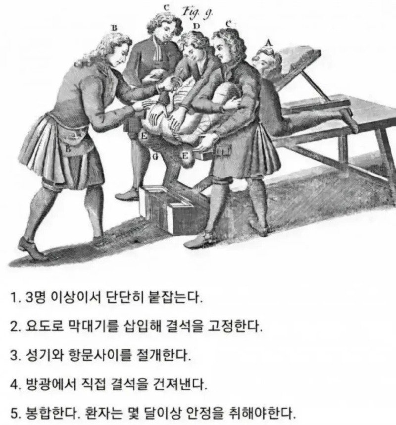 중세시대 요로결석 제거법