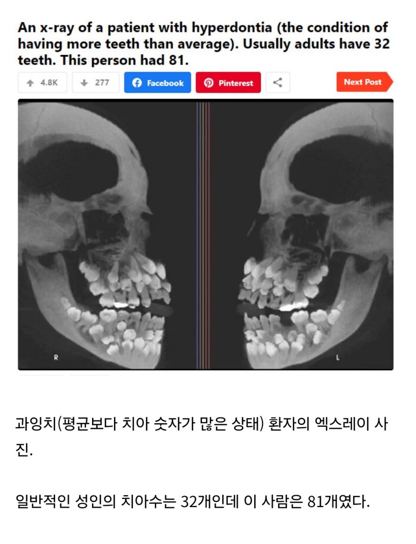 과잉치 레전드