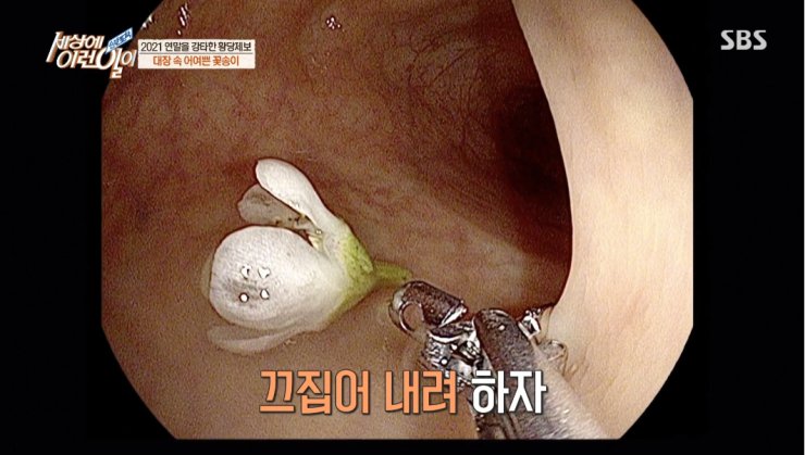 대장내시경하다 발견된거