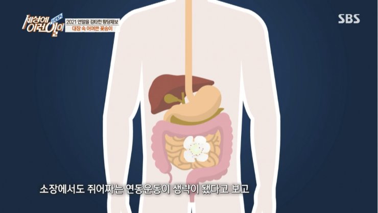 대장내시경하다 발견된거