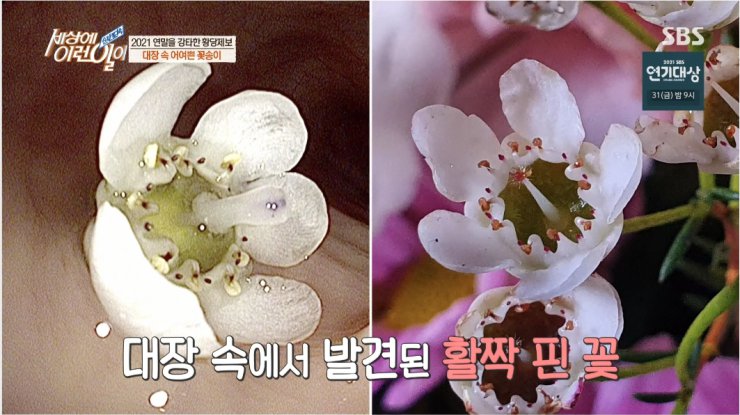 대장내시경하다 발견된거