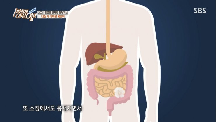 대장내시경하다 발견된거