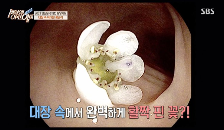 대장내시경하다 발견된거