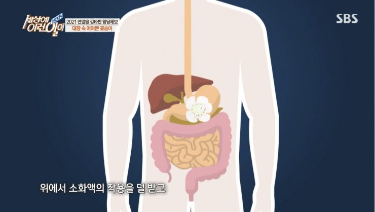 대장내시경하다 발견된거