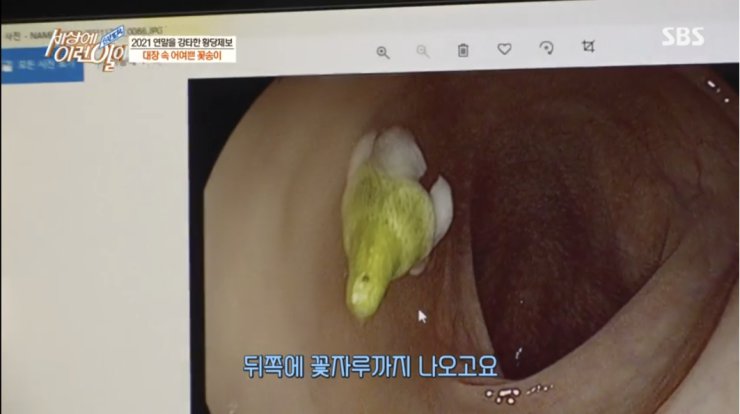 대장내시경하다 발견된거