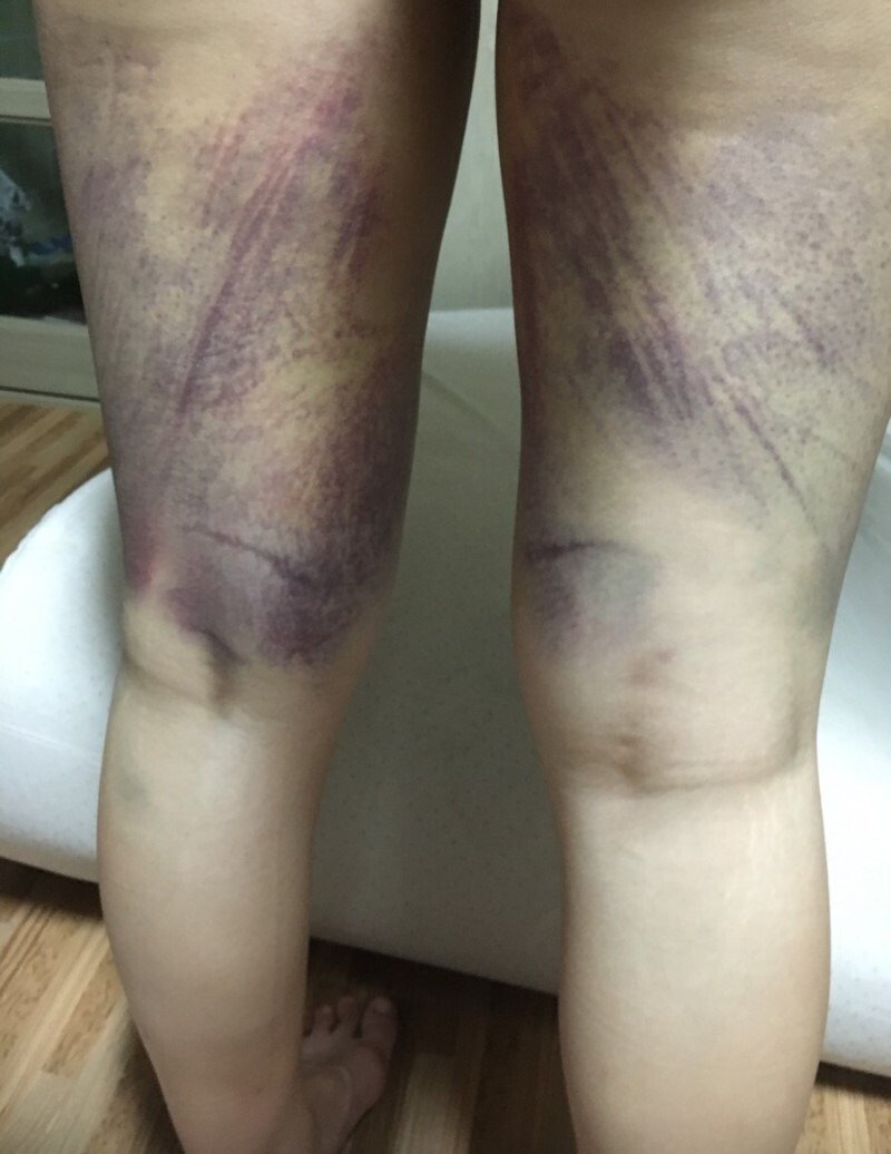 승마운동의 효과