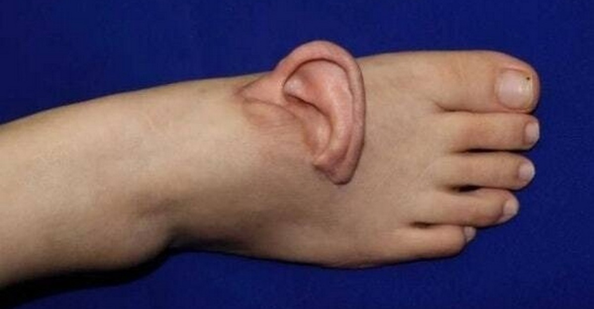 (약혐) 5개월 동안 &#039;발등&#039;에 귀 달고 다닌 여성의 사연