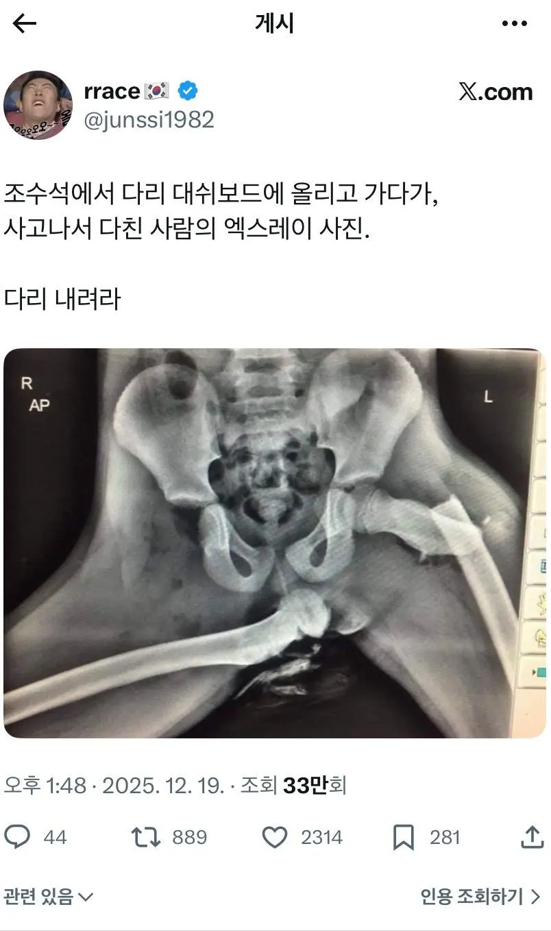 (약혐) 조수석에 다리 올리고 가다가 사고난 사람의 엑스레이 사진