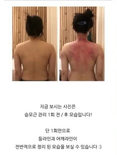 승모근 교정 후기